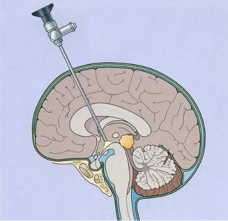 https://www.hidrocefaliaperu.com/assets/paginaweb/wp-content/services/Endoscopia_cerebral.jpg