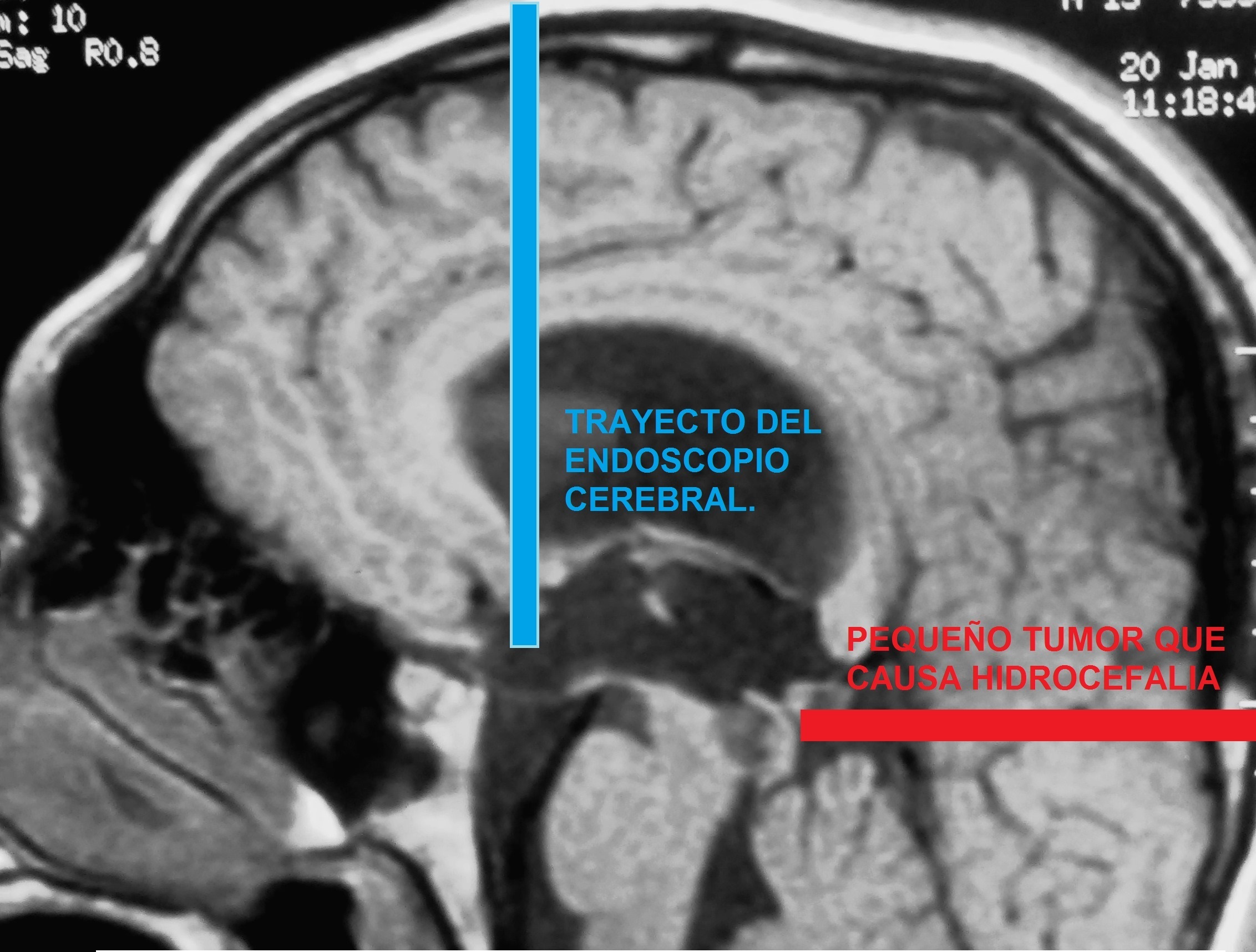 https://www.hidrocefaliaperu.com/assets/paginaweb/wp-content/services/hidrocefalia_obstructiva.jpg