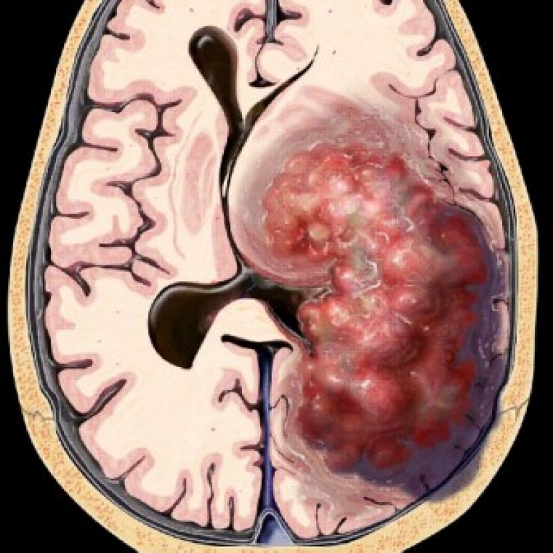 https://www.hidrocefaliaperu.com/assets/paginaweb/wp-content/services/neurocirugia.jpg