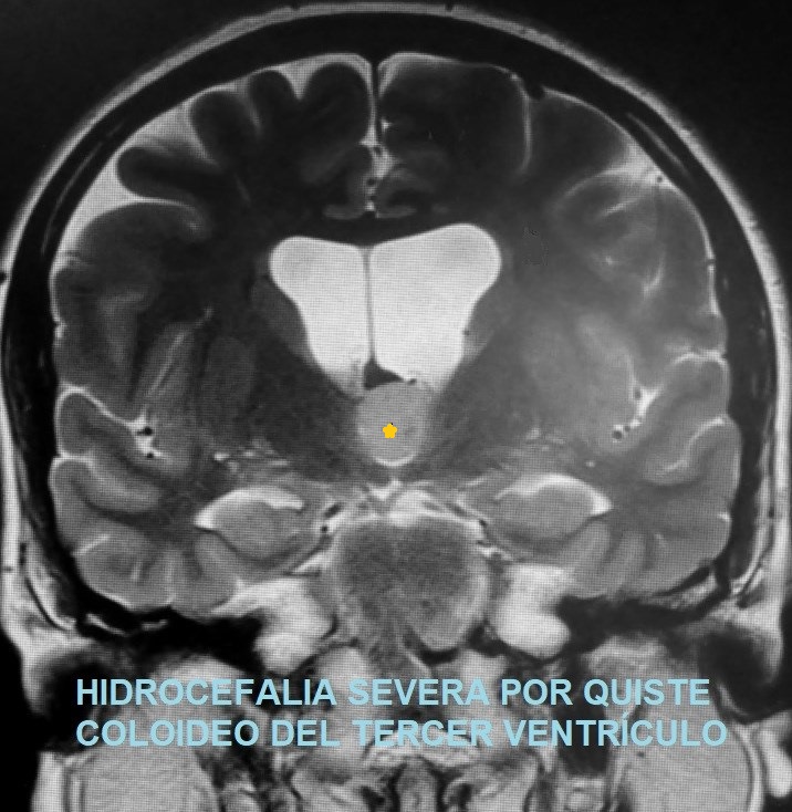QUISTES COLOIDES CEREBRALES