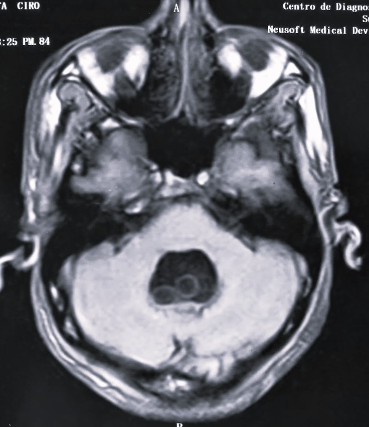 HIDROCEFALIA POR NEUROCISTICERCOSIS