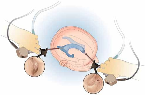 Hidrocefalia por endoscopía en Lima - Perú