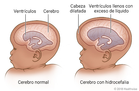 ¿Que es hidrocefalia?