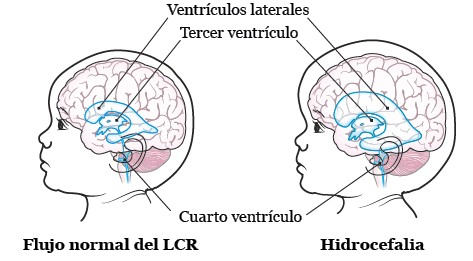 Caso de hidrocefalia